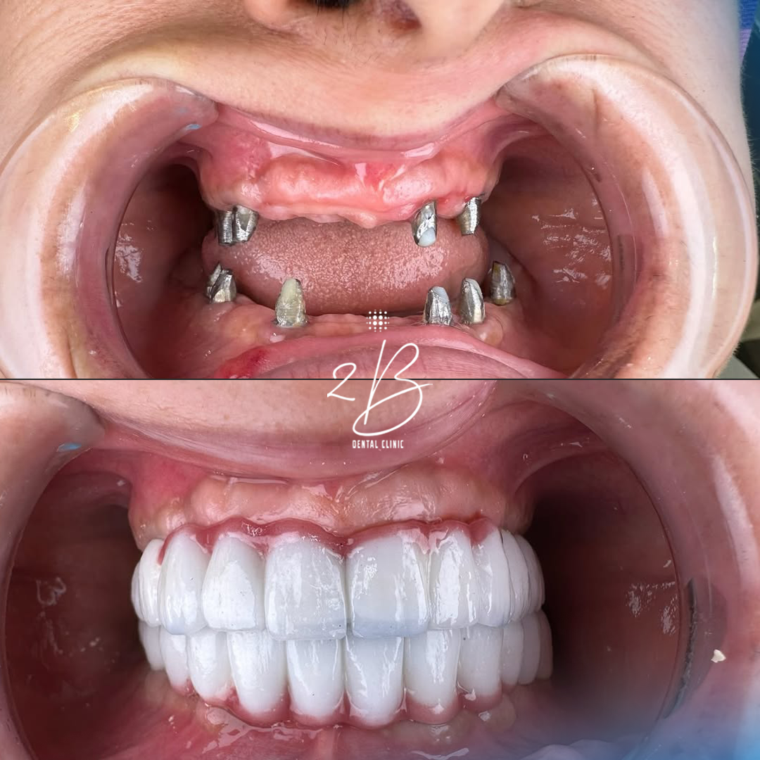 Before & After - Hollywood Smile Transformation