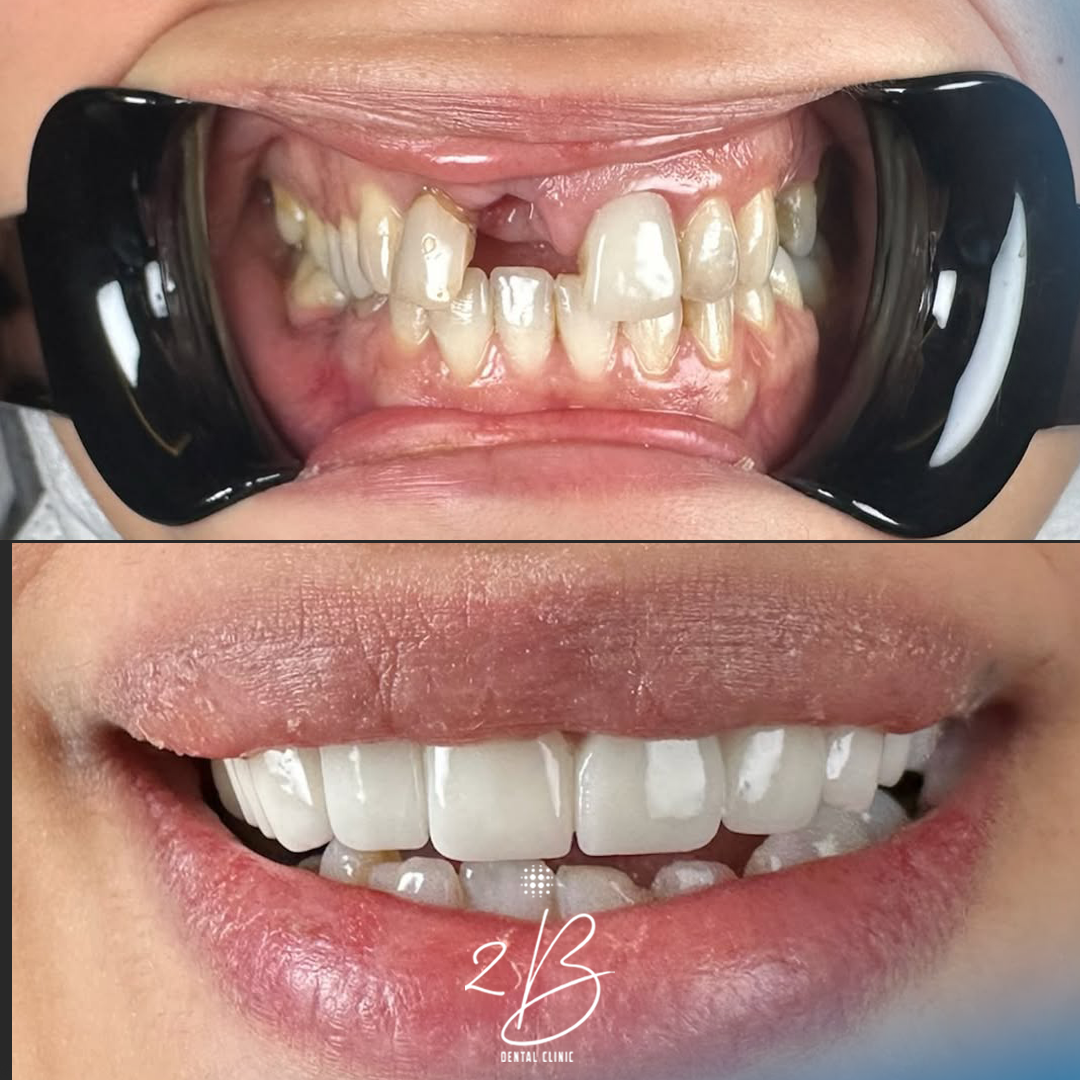 Before & After - Perfect Alignment Transformation