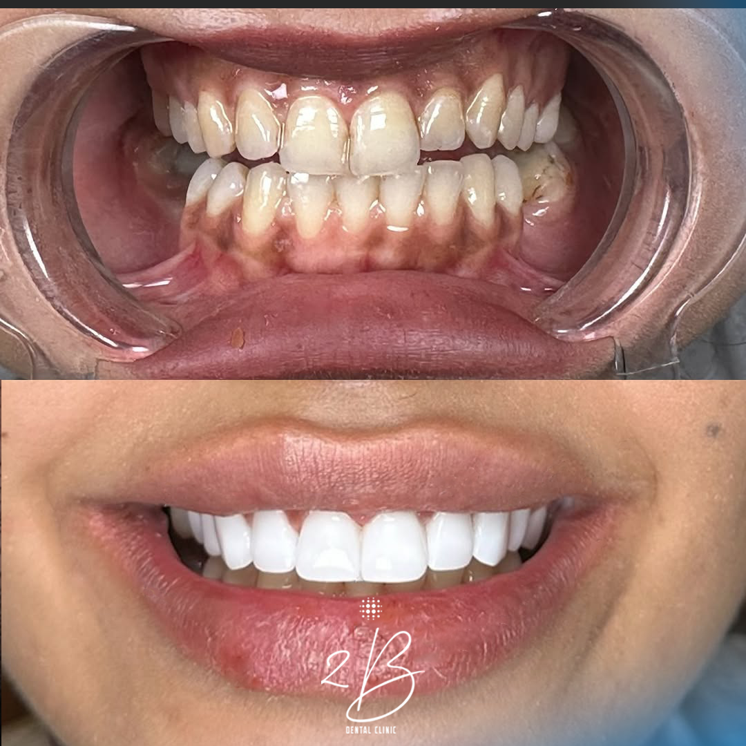 Before & After - Perfect Smile Transformation